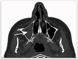 sinus mri